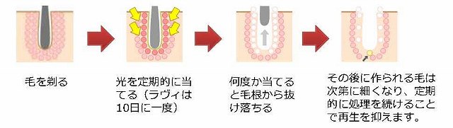 IPL光美顔の仕組み3